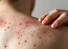 Confirman primer fallecimiento por sarampión en CDMX; suman 28 muertes en México